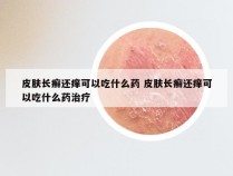 皮肤长癣还痒可以吃什么药 皮肤长癣还痒可以吃什么药治疗