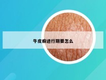 牛皮癣进行期要怎么