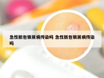 急性脓包银屑病传染吗 急性脓包银屑病传染吗