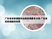 广东省皮肤病医院治银屑病要多少钱 广东省皮肤病医院收费