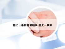 腿上一条藓越来越长 腿上一块癣