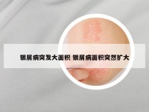 银屑病突发大面积 银屑病面积突然扩大