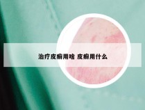 治疗皮癣用啥 皮癣用什么