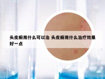 头皮癣用什么可以治 头皮癣用什么治疗效果好一点