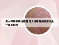 男人得银屑病的原因 男人得银屑病的原因是什么引起的