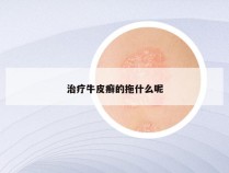 治疗牛皮癣的拖什么呢