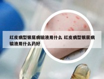 红皮病型银屑病输液用什么 红皮病型银屑病输液用什么药好