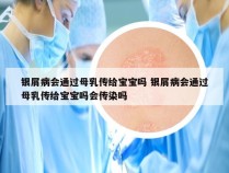 银屑病会通过母乳传给宝宝吗 银屑病会通过母乳传给宝宝吗会传染吗