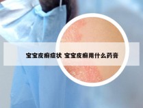 宝宝皮癣症状 宝宝皮癣用什么药膏