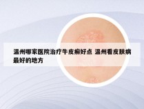 温州哪家医院治疗牛皮癣好点 温州看皮肤病最好的地方