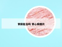 掌藓能治吗 掌心癣图片