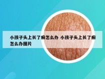 小孩子头上长了癣怎么办 小孩子头上长了癣怎么办图片