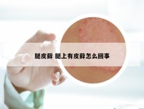 腿皮藓 腿上有皮藓怎么回事