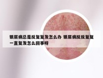 银屑病总是反复复发怎么办 银屑病反反复复一直复发怎么回事呀