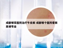 成都哪家医院治疗牛皮癣 成都哪个医院看银屑病专业