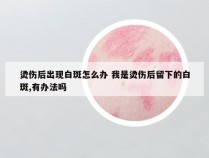 烫伤后出现白斑怎么办 我是烫伤后留下的白斑,有办法吗