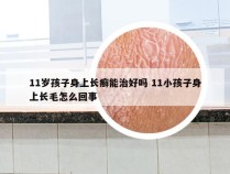 11岁孩子身上长癣能治好吗 11小孩子身上长毛怎么回事