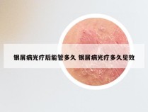 银屑病光疗后能管多久 银屑病光疗多久见效