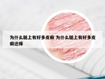 为什么腿上有好多皮癣 为什么腿上有好多皮癣还痒