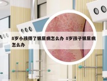 8岁小孩得了银屑病怎么办 8岁孩子银屑病怎么办