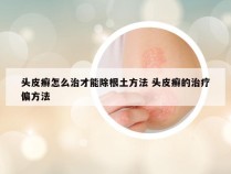 头皮癣怎么治才能除根土方法 头皮癣的治疗偏方法