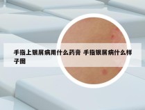 手指上银屑病用什么药膏 手指银屑病什么样子图