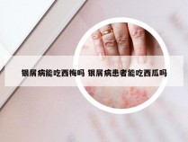 银屑病能吃西梅吗 银屑病患者能吃西瓜吗