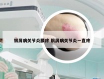 银屑病关节炎腰疼 银屑病关节炎一直疼