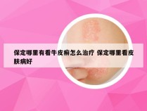 保定哪里有看牛皮癣怎么治疗 保定哪里看皮肤病好