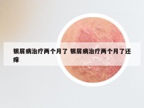 银屑病治疗两个月了 银屑病治疗两个月了还痒