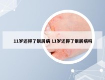 11岁还得了银屑病 11岁还得了银屑病吗