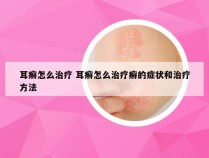 耳癣怎么治疗 耳癣怎么治疗癣的症状和治疗方法