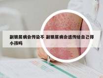 副银屑病会传染不 副银屑病会遗传给自己得小孩吗