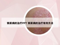 银屑病的治疗PPT 银屑病的治疗有效方法