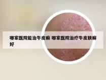 哪家医院能治牛皮癣 哪家医院治疗牛皮肤癣好