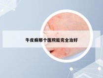 牛皮癣那个医院能完全治好