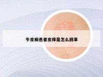 牛皮癣患者皮痒是怎么回事