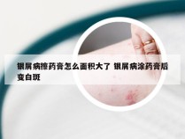 银屑病擦药膏怎么面积大了 银屑病涂药膏后变白斑