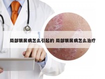 局部银屑病怎么引起的 局部银屑病怎么治疗