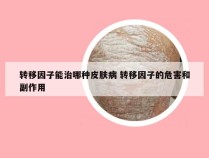 转移因子能治哪种皮肤病 转移因子的危害和副作用