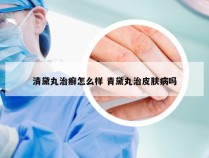 清黛丸治癣怎么样 青黛丸治皮肤病吗