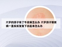 六岁的孩子有了牛皮癣怎么办 六岁孩子银屑病一直反反复复下去起来怎么办