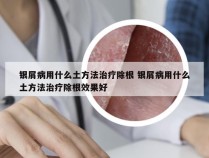 银屑病用什么土方法治疗除根 银屑病用什么土方法治疗除根效果好