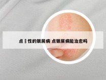 点滳性的银屑病 点银屑病能治愈吗