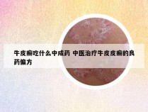 牛皮癣吃什么中成药 中医治疗牛皮皮癣的良药偏方