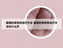 面癣的症状和治疗方法 面癣的症状和治疗方法吃什么药