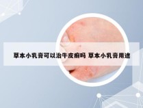 草本小乳膏可以治牛皮癣吗 草本小乳膏用途