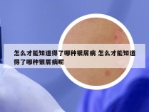 怎么才能知道得了哪种银屑病 怎么才能知道得了哪种银屑病呢