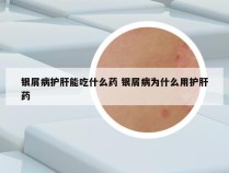 银屑病护肝能吃什么药 银屑病为什么用护肝药