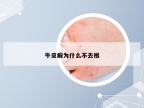 牛皮癣为什么不去根